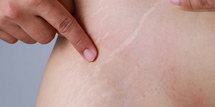 How Remove Stretch Marks Safely and Effectively Without Any Downtime