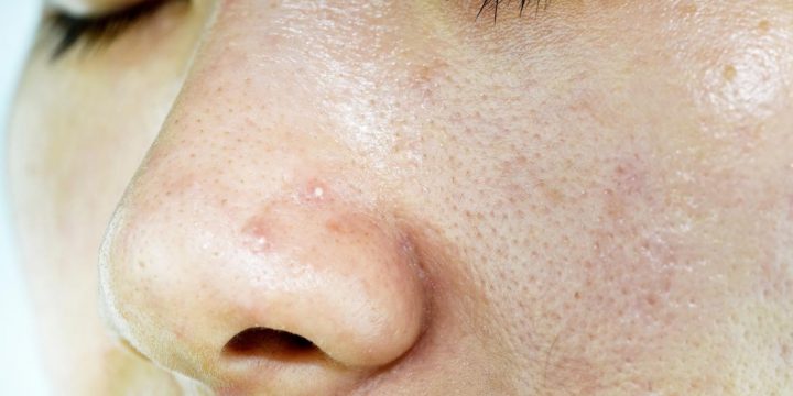 What You Need To Know About Oily Skin Care