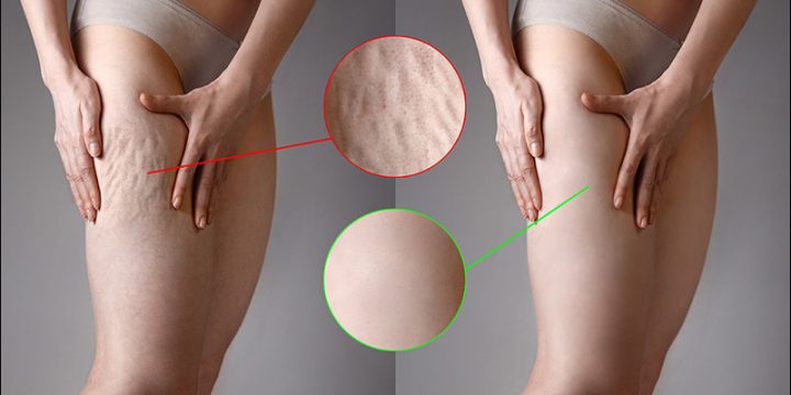 Best Cellulite Treatments to Help Get Rid of Cellulite in the Legs and Thighs