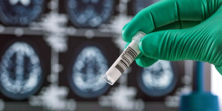 Experimental Alzheimer’s Drug Slows Cognitive Decline