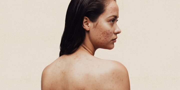 If You Wrote a Letter to Your Acne, What Would You Say?