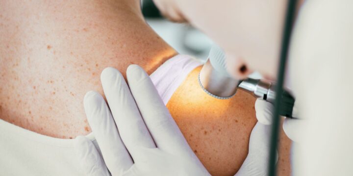 Immunotherapy Given Before Target Therapy Improves Advanced Melanoma Survival Rates