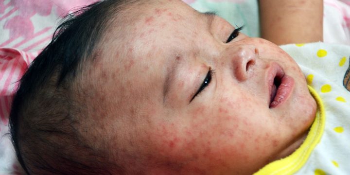 Worsening Measles Outbreak Threatens Unvaccinated Kids