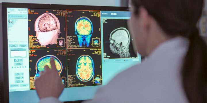 Brain Scan Can Aid Early Detection of Alzheimer’s Disease