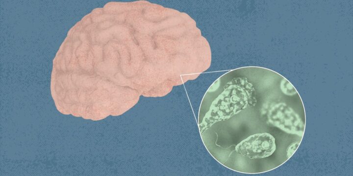 Man Infected With Brain-Eating Amoeba After Visiting Iowa Beach