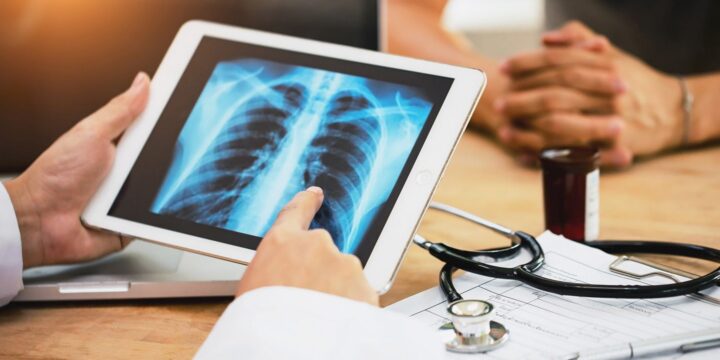 Nearly Half of People With Abnormal Lung Cancer Screening Postpone Follow-Up Care