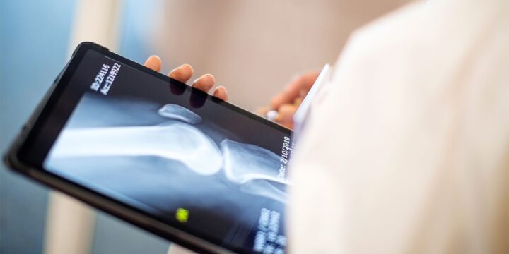 Osteoarthritis Research: News You Can Use From EULAR 2022