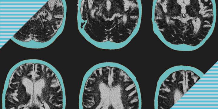FDA Okays New Alzheimer’s Drug, Despite Controversy