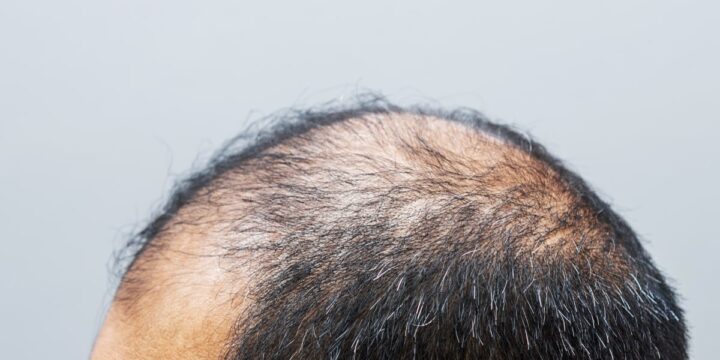 Minoxidil, drug that treats thinning hair, may be in short supply