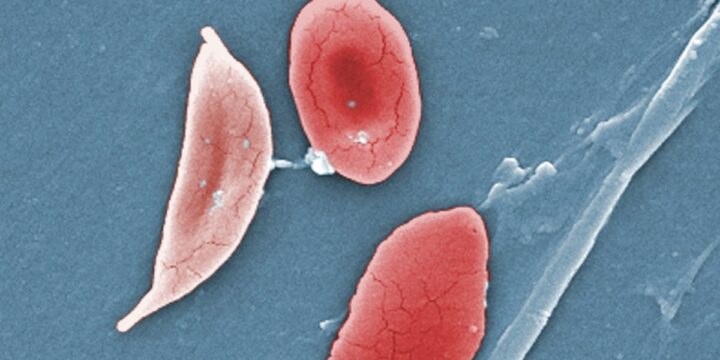 FDA moves closer to sickle cell cure that uses gene editing