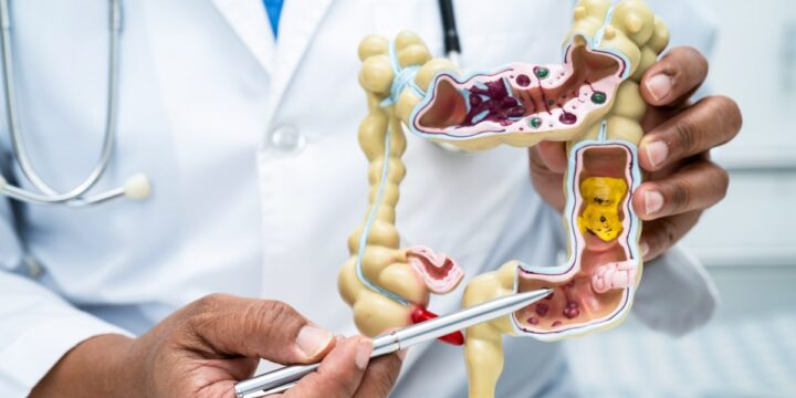 A new type of bacteria was found in 50% of colon cancers. Many were aggressive cases.